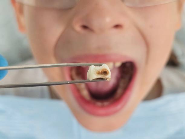 Best Emergency Tooth Extraction in Circleville, OH